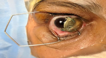 Inserting Ru-106 Plaque for eye cancer treatment